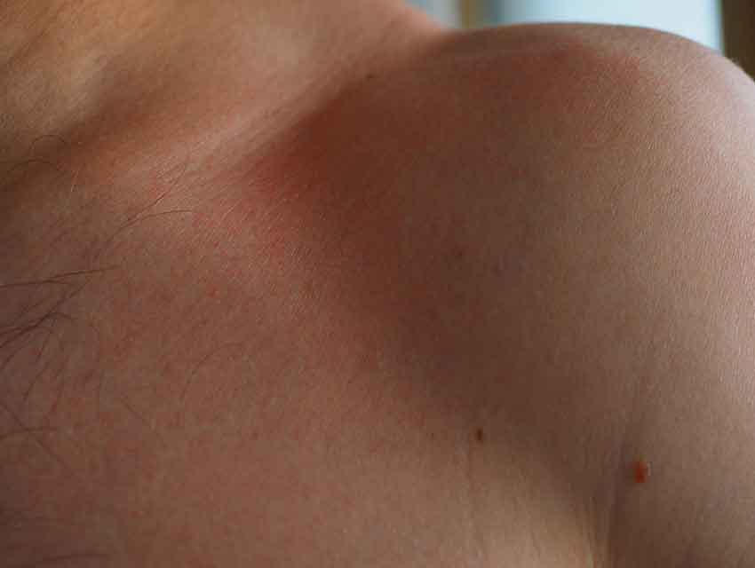 Blaue Flecken an der Schulter oder Beine entstehen nach einer langen Thaimassage oder Massage. Etwas gerötete Stelle, der Schmerz verursachen kann. Alles sollte innerhalb weniger Tage wieder verschwunden sein.