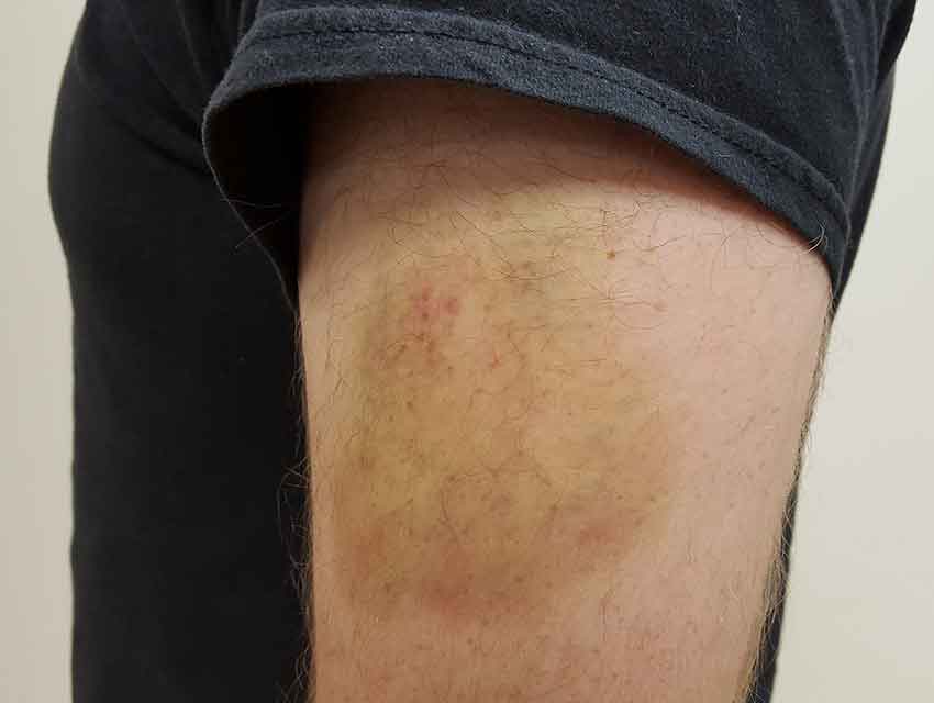 Ein blauer Fleck (Hämatom) auf dem Bein vom Patient. So könnte nach einer Massage (Triggerpunkte) ein Hämatom über dem Muskel aussehen und Schmerz verursachen. Bild-Beitrag: Wikipedia