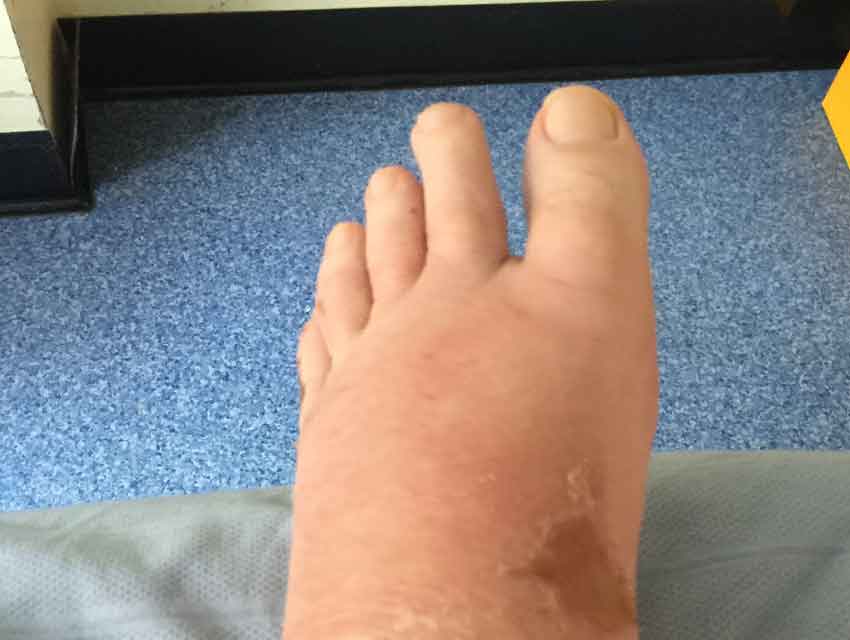 Ödem am Fuß bei einem Patienten, das wahrscheinlich Schmerz verursacht. - Bild-Beitrag Wikimedia
